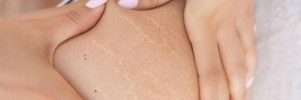 ¿Cómo combatir las tan detestadas estrías en la piel? Conoce los siguientes trucos.