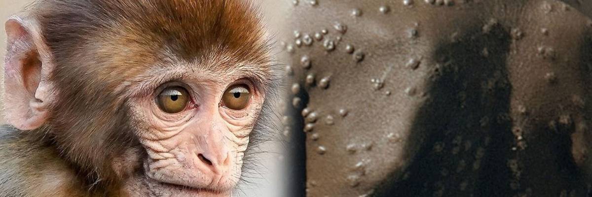 Viruela del Mono: ¿Estamos a las puertas de una nueva pandemia? Todo lo que necesitas saber sobre esta enfermedad.