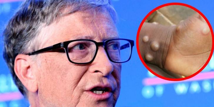 Bill Gates y la Viruela del Mono: Parece que las predicciones del fundador de Microsoft resultaron ciertas.