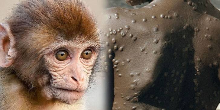 Viruela del Mono: ¿Estamos a las puertas de una nueva pandemia? Todo lo que necesitas saber sobre esta enfermedad.