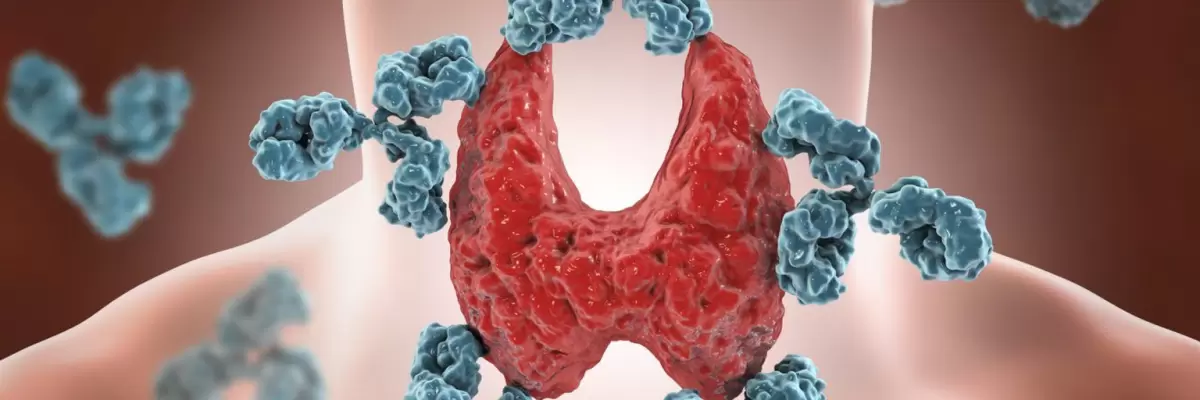 Tiroiditis de Hashimoto: Inmunopatía de la tiroides